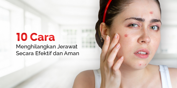 10 Cara Menghilangkan Jerawat Secara Efektif dan Aman
