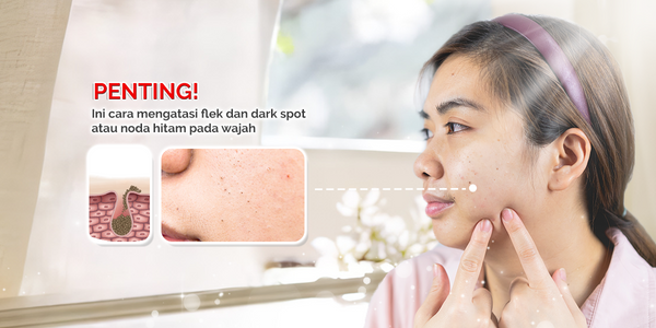 Semua tentang Flek Hitam! Perbedaan, Penyebab & Solusi